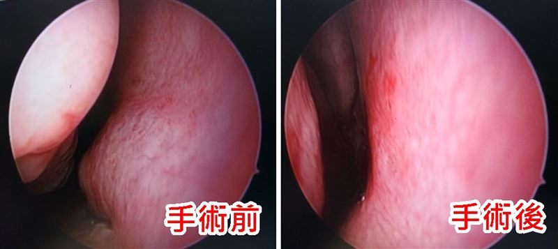 經過「後鼻神經燒灼」合併治療,病人找回乾爽呼吸的鼻腔。(圖/臺北醫院提供)