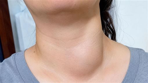 50歲女脖子凸沒感覺！竟罹癌 4症狀快就醫