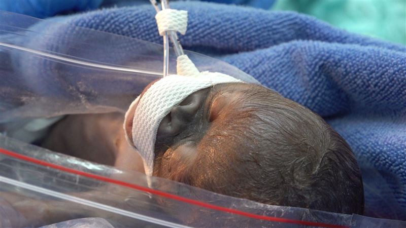 紅毛猩猩剖腹產雙胞胎 1死1全力搶救中