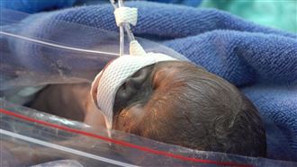 紅毛猩猩剖腹產雙胞胎　1死1全力搶救中