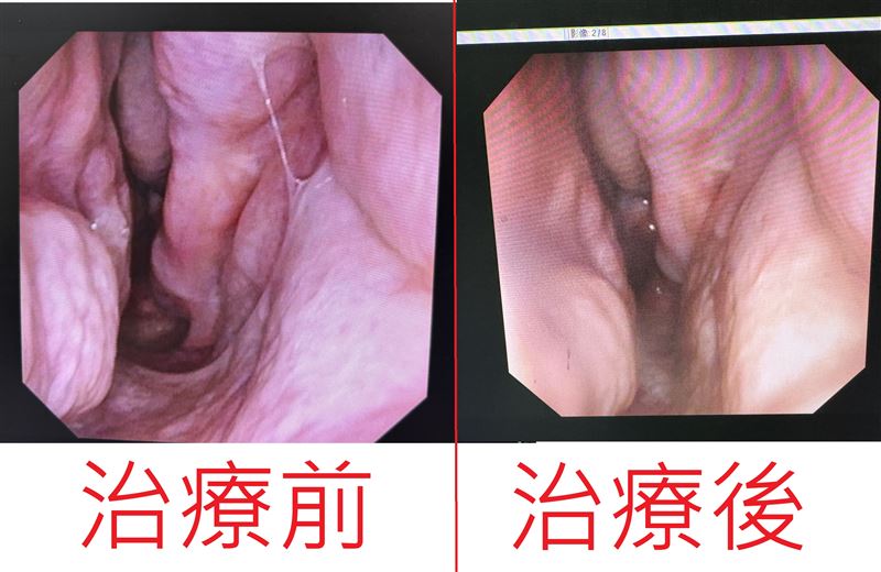 治療後重新縮小鼻腔體積,引導氣流回歸正常路徑,是目前較具成效的根治方案。(圖/烏日林新醫院提供)