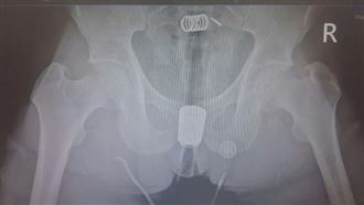 炸裂！38歲男「馬桶噴頭」塞肛門卡死