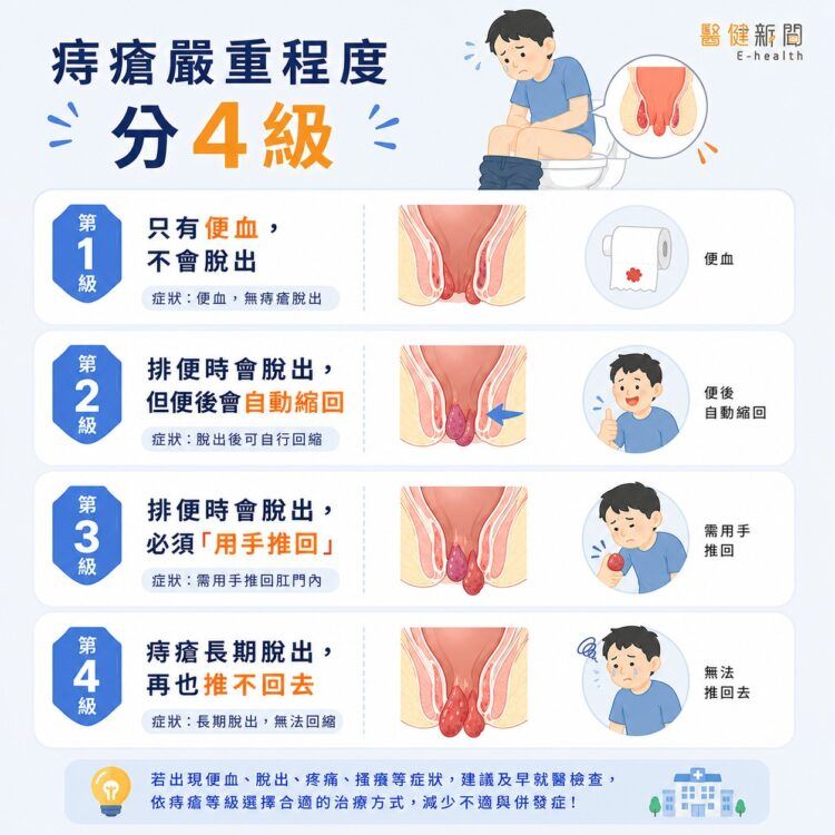 陳威智醫師指出，臨床上，醫師通常會依照「內痔脫垂的程度」，將痔瘡分為1到4級。（圖／醫健新聞網提供）