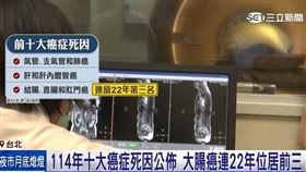 114年十大癌症死因 大腸癌連續22年居前三
