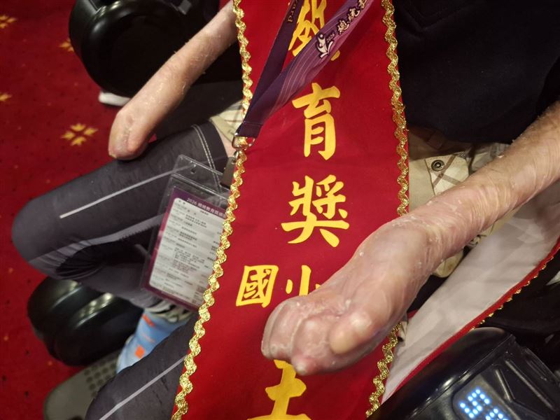 2026年總統教育獎得主之一、新北市土城國小學生王柏權,因罹患罕見疾病「先天性表皮分解性水泡症」(俗稱泡泡龍),身上皮膚無一處完好,連手指也因反覆受傷產生沾黏。(圖/記者周佩怡攝影)