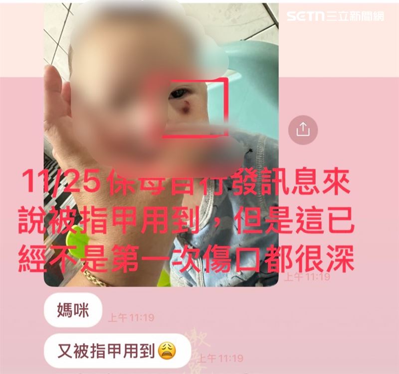 5個月大的嬰兒送托後屢帶傷痕回家,保母推托是「指甲弄傷」。(圖/家長提供)