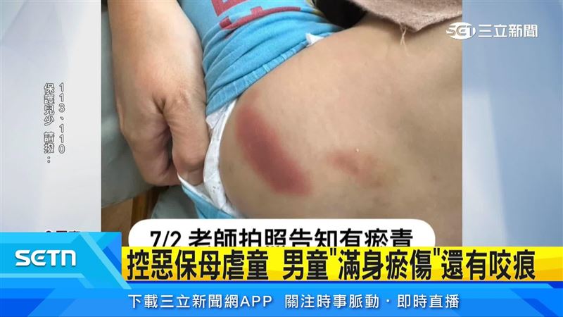 屏東一名母親控訴2歲兒子疑似遭到保母虐待,全身有多處瘀青挫傷