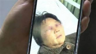 媳婦打斷婆婆肋骨　兒嗆「不帶孫就給錢」