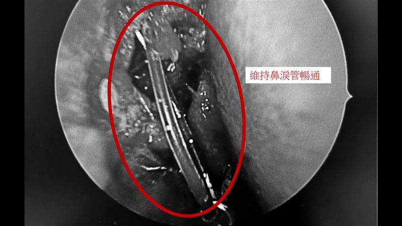 「流目油」恐是鼻淚管阻塞 4症狀注意