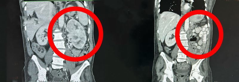 患者左腎長出6公分腫瘤,確診第四期腎細胞癌,且已出現肺部轉移。(圖/豐原醫院提供)