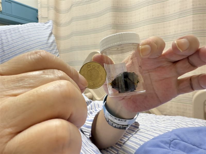 醫療團隊先以內視鏡清除總膽管結石,再透過引流術排出發炎膽汁,待2週後發炎控制,再以腹腔鏡切除膽囊,並取出約3公分的膽結石。(圖/衛福部彰化醫院提供)