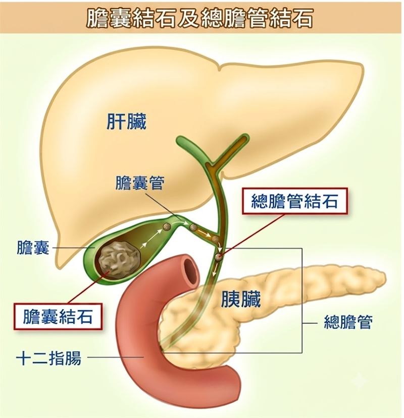 余明昌提醒,多數膽結石沒有症狀,但若掉入總膽管,恐引發阻塞、感染甚至危及生命。建議2公分以上結石評估切除膽囊,平時也應採低脂、高纖飲食,避免暴飲暴食。(示意圖/衛福部彰化醫院提供)