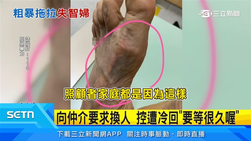 家屬帶老婦人驗傷,發現腿部膝蓋有瘀青擦挫傷