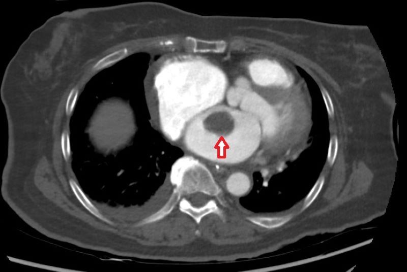 電腦斷層明顯看到4公分的巨大血栓。(圖/台北慈濟醫院提供)
