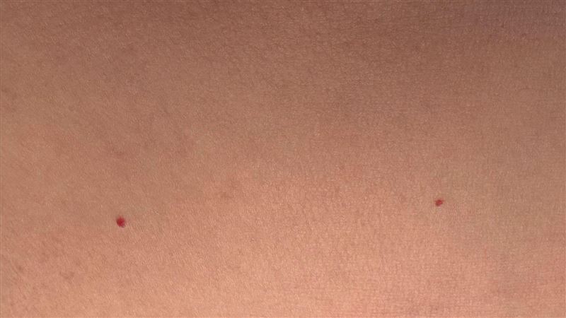 身上冒紅色小凸點怕是癌！醫提醒這件事