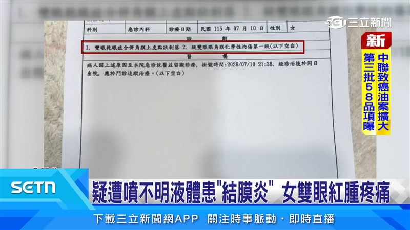 D小姐遭陌生女子持疑似酒精的液體噴灑後,回家後還出現不適,雙眼紅腫疼痛難耐,疑似罹患結膜炎
