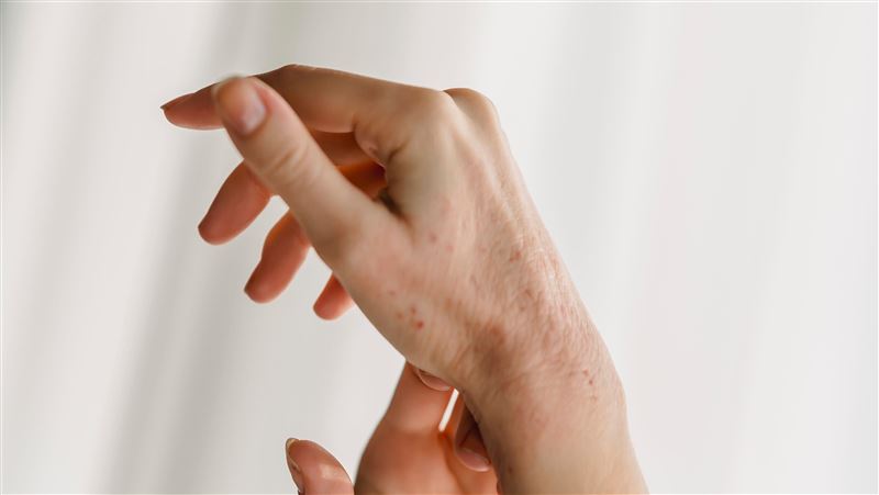 男子身上長皮疹遲遲未消,檢查後竟感染第二期梅毒。(示意圖/翻攝自PEXELS)