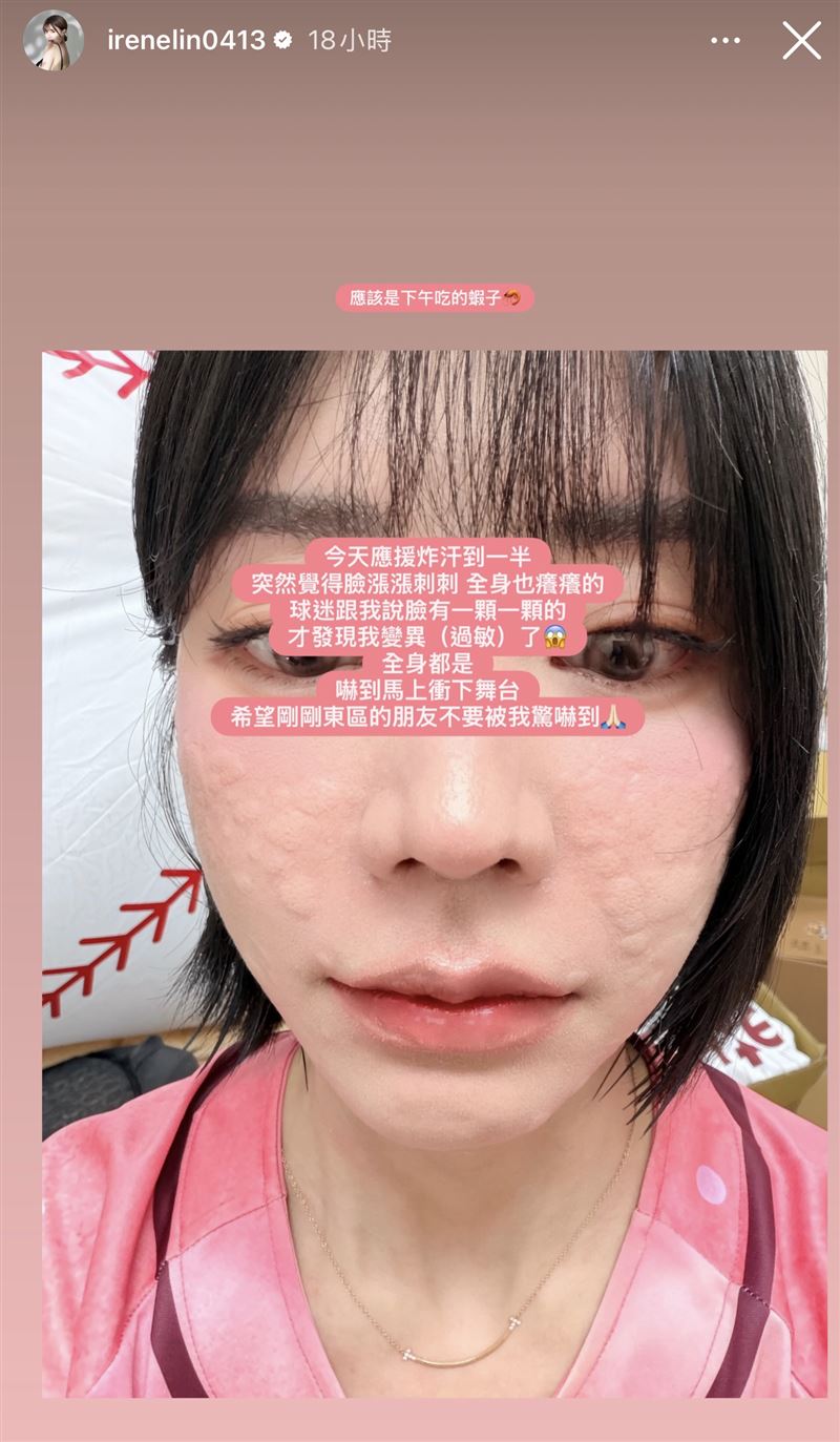 林艾融貼出臉蛋佈滿顆粒的畫面。(圖/翻攝自IG)