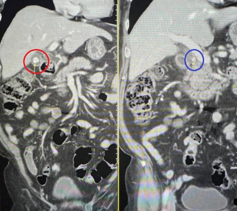 拖了半年後,科技主管體內的結石早已掉落並死死堵塞住總膽管,引發嚴重的急性膽管炎,甚至已出現早期敗血性休克、血壓暴跌!(圖/翻攝畫面)