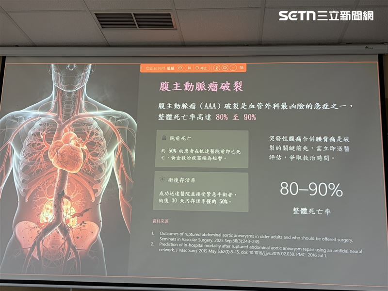 腹主動脈瘤破裂是心血管外科最凶險的急症之一,若未及時手術,死亡率高達8成以上。(圖/記者簡浩正攝影)