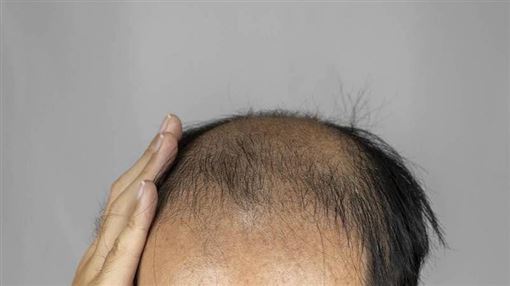 雄性禿藏意外好處　研究揭掉髮男1優勢