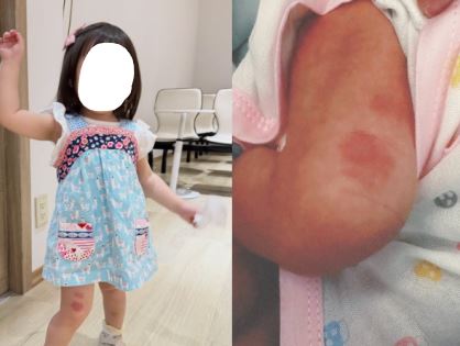 熊熊近日在網路上公開關於女兒鈮霓腿上紅斑的真相。(圖/翻攝自IG @bearmars2023214)
