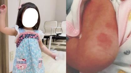 愛女腿上紅印遭關切　熊熊出面回應了