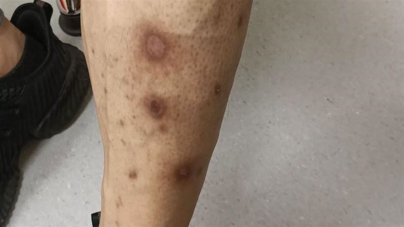 小腿有咖啡色斑點 他一驗愣:竟得糖尿病