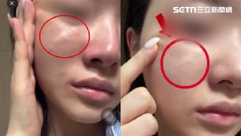 獨／醫美打一針「長硬塊」醫：嚴重恐動刀