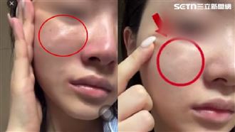 獨／醫美打一針「長硬塊」醫：嚴重恐動刀