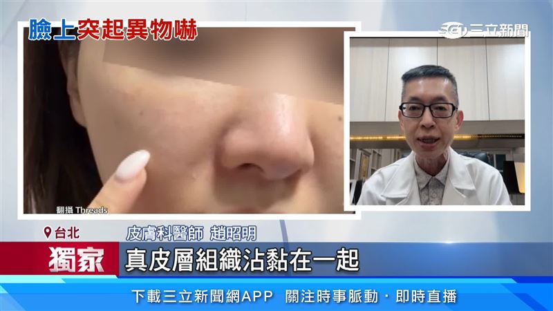結節是因為真皮層組織沾黏