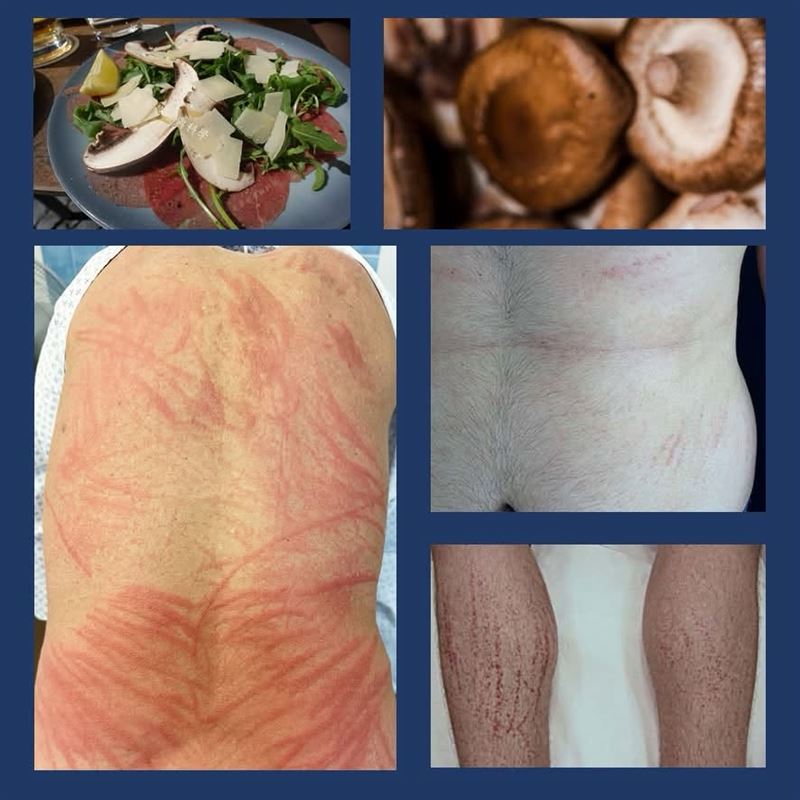 營養師提醒，若食用未煮熟的香菇，全身可能冒出一道道宛如遭鞭子抽打過的紅色皮疹。（圖／翻攝自老辜營養與科學臉書）