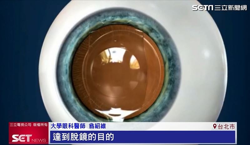 EVO ICL「膠原蛋白眼內鏡」，透過將專利膠原蛋白晶體植入眼內，無須改變角膜結構，適合高度近視或角膜較薄，有視力矯正需求的患者