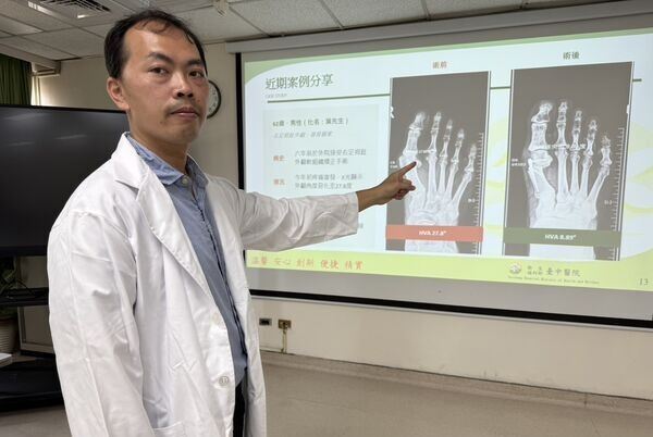62歲男拇指外翻復發，登山走到一半痛到受不了！醫師截骨矯正助他重返山林，體驗登山樂趣（圖／台中醫院提供）