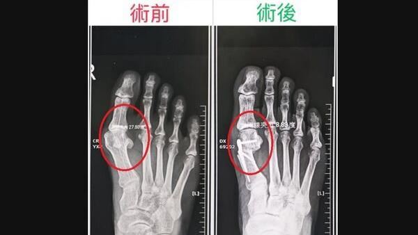 醫「1動作」測拇指外翻　超過1角度得動刀