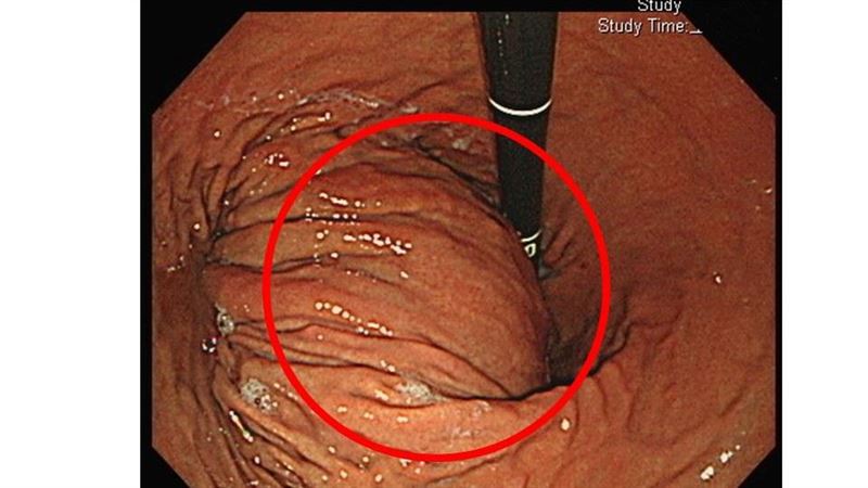 他腹悶半年就醫「胃後方突一塊」竟是癌症