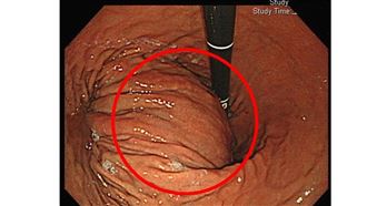 他腹悶半年就醫「胃後方突一塊」竟是癌症