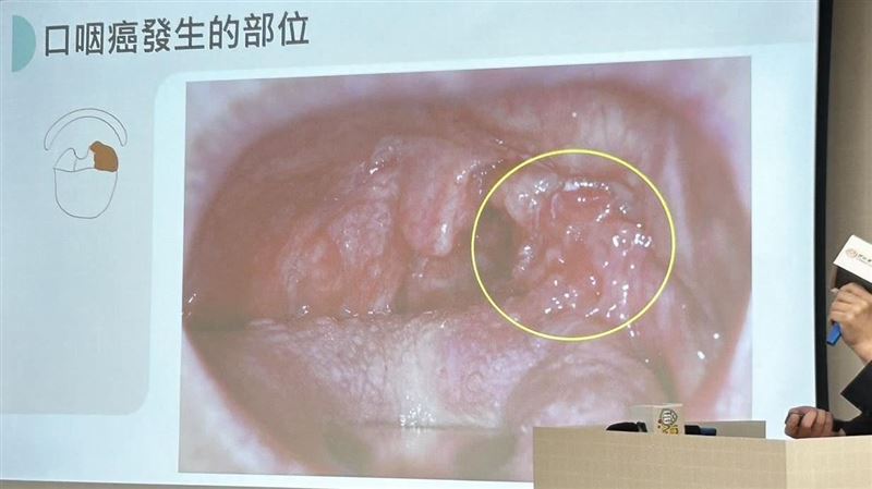 醫師提及，口咽癌發生率超越子宮頸癌，成為最常見的HPV相關癌症之一。（圖／記者簡浩正攝影）