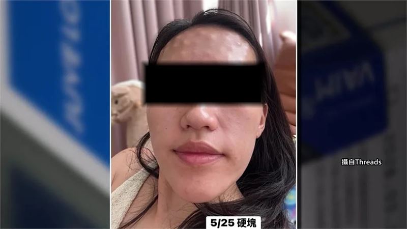 赴韓做醫美變噩夢！女子打素顏針後現結節...額頭長滿顆粒。（圖／翻攝自Threads）