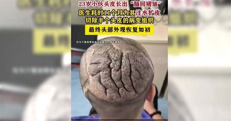23歲男子罹患罕見頭皮疾病,頭皮長出宛如大腦腦迴的皺褶,歷經11個月治療後終於恢復正常。(圖/翻攝自極目新聞)