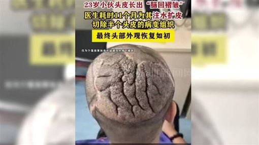 頭頂竟長出「大腦」！男怪病纏身原因曝