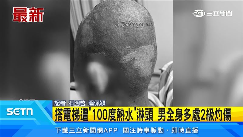 男子遭鄰居尾隨進電梯後,竟被100度熱水迎頭澆下,全身多處二度燙傷