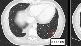 常誤認肌肉不適！她罹罕見肉瘤截肢又復發