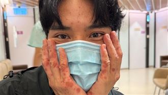 男星被蟲咬送急診搶命！全身紅疹喉嚨腫脹