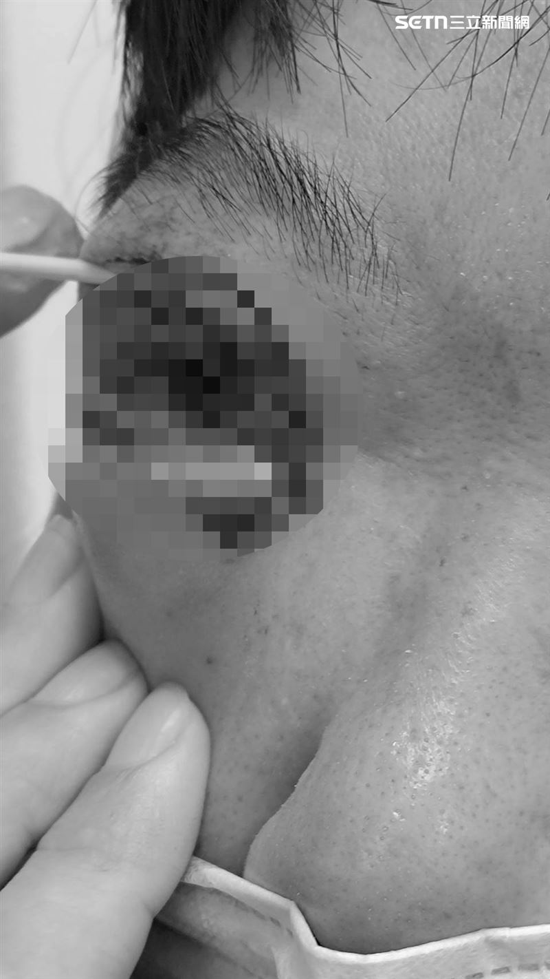 34歲女老師遭學生持掃把攻擊，右眼傷勢照曝光。（圖／民眾提供）