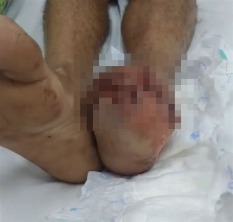 男子腳掌骨頭、肌肉組織嚴重摧毀,只能將受損的腳掌截除。(圖/翻攝自網路)