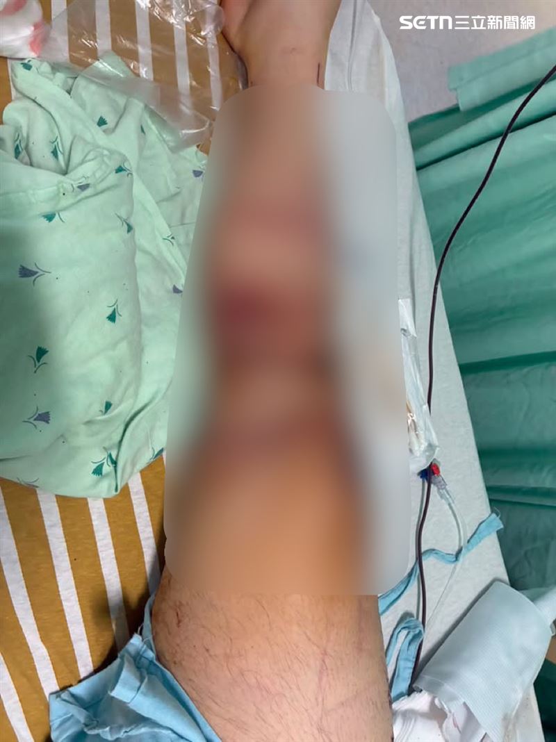 男大生右腿傷痕遍布。（圖／當事人提供）