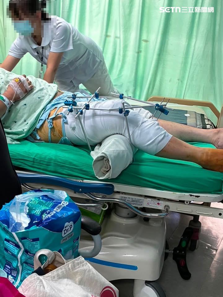男大生大腿骨折，腿骨斷成三截，週一還要進行第三次手術。（圖／當事人提供）