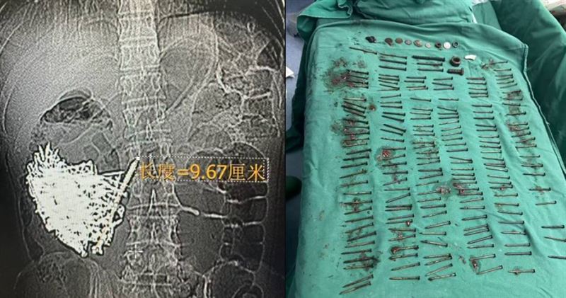大陸雲南一名36歲男子連續9天腹痛又嘔吐,就醫檢查發現胃裡竟有180根鐵釘。(圖/翻攝自微博/極目新聞)