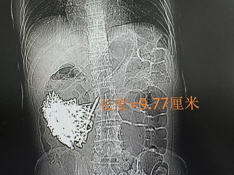 腹部X光拍下，男子的消化道中有大量鐵釘及金屬物，最長的鐵釘有9.77公分。（圖／翻攝自澎湃新聞）